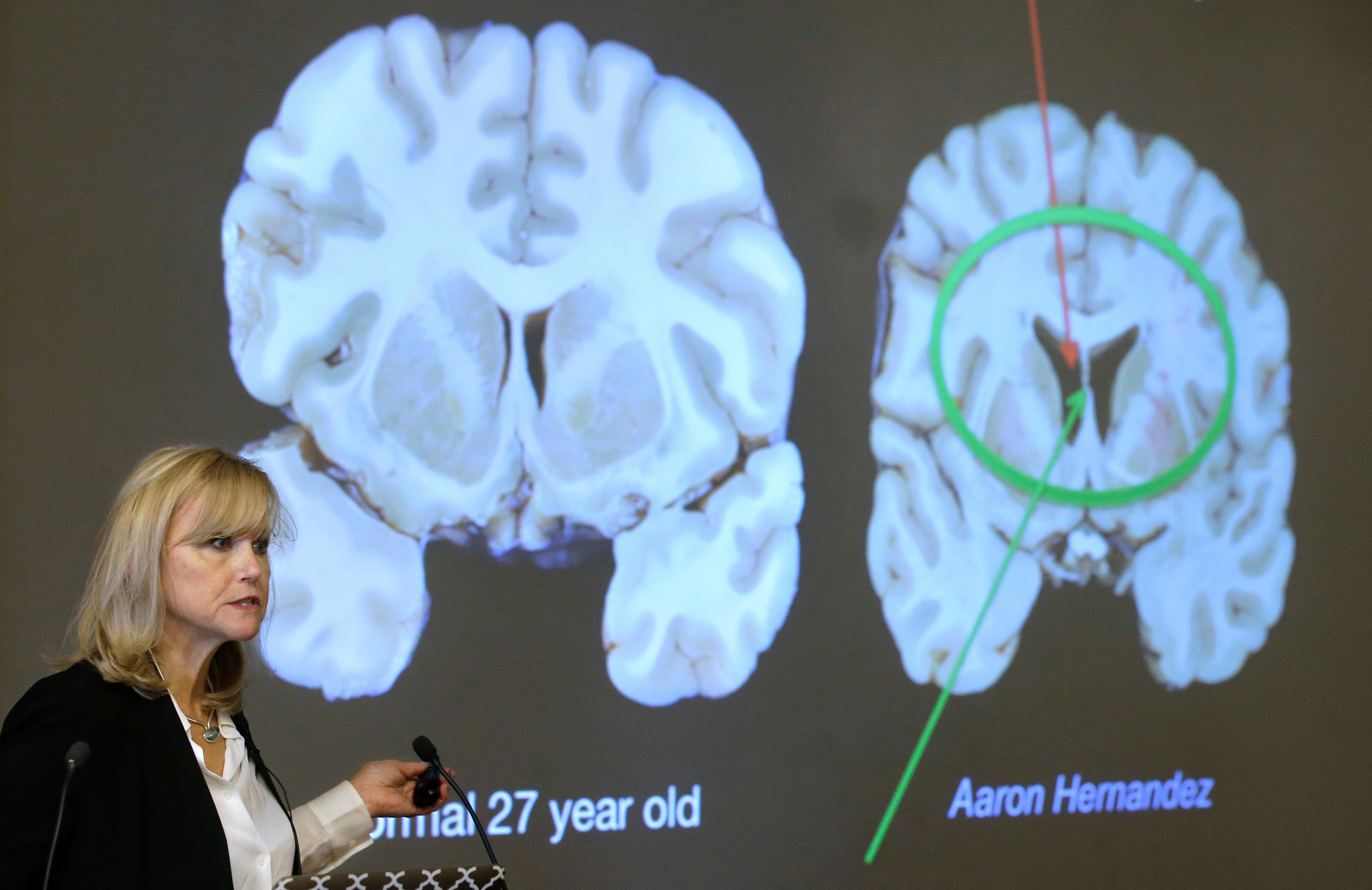 FILE - Ann McKee, director Boston University's center for research into the degenerative brain disease chronic traumatic encephalopathy, or CTE, addresses an audience on the school's campus Nov. 9, 2017 about the study of NFL football player Aaron Hernandez's brain, projected on a screen, behind right, in Boston. 