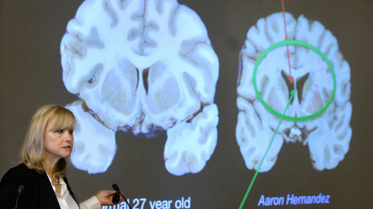 FILE - Ann McKee, director Boston University's center for research into the degenerative brain disease chronic traumatic encephalopathy, or CTE, addresses an audience on the school's campus Nov. 9, 2017 about the study of NFL football player Aaron Hernandez's brain, projected on a screen, behind right, in Boston.