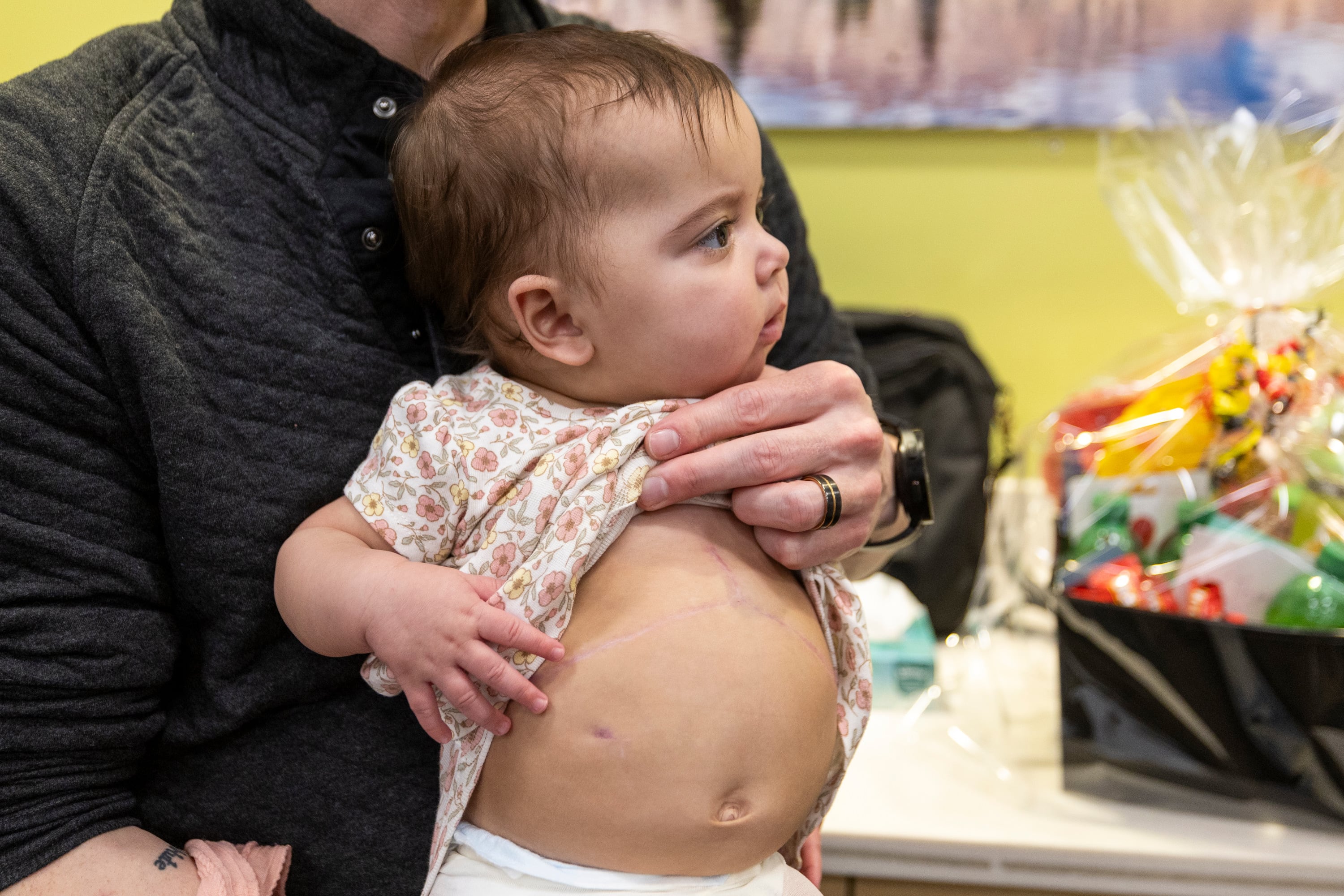 Justin Tibbs pulls up his daughter Elieanna’s shirt to show the scar from her liver transplant during a media event for Utah's first pediatric paired liver exchange at Intermountain Primary Children’s Hospital in Salt Lake City on Friday.