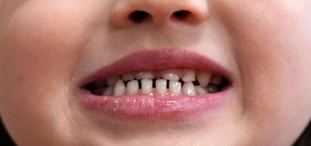 FDA moves to restrict fluoride supplements as part of MAHA agenda