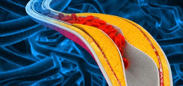 Pill may lower cholesterol in those who don't see benefit with statins alone