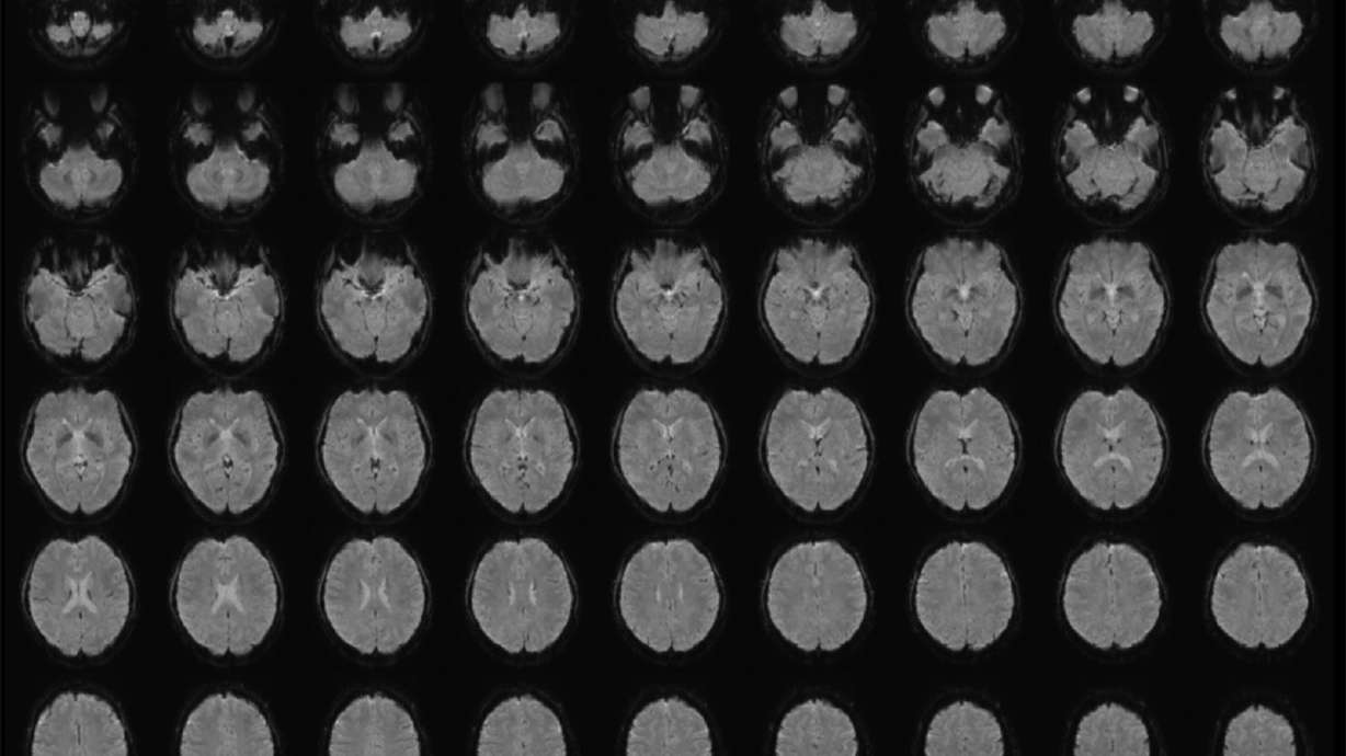 Functional magnetic resonance imaging is a non-invasive technique that measures brain activity. A scientist in Japan has developed a technique that uses brain scans and artificial intelligence to turn a person's mental images into accurate, descriptive sentences.