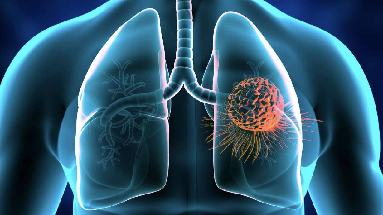 Radon is the second leading cause of lung cancer in the United States, and the only way to detect it is by testing your home.