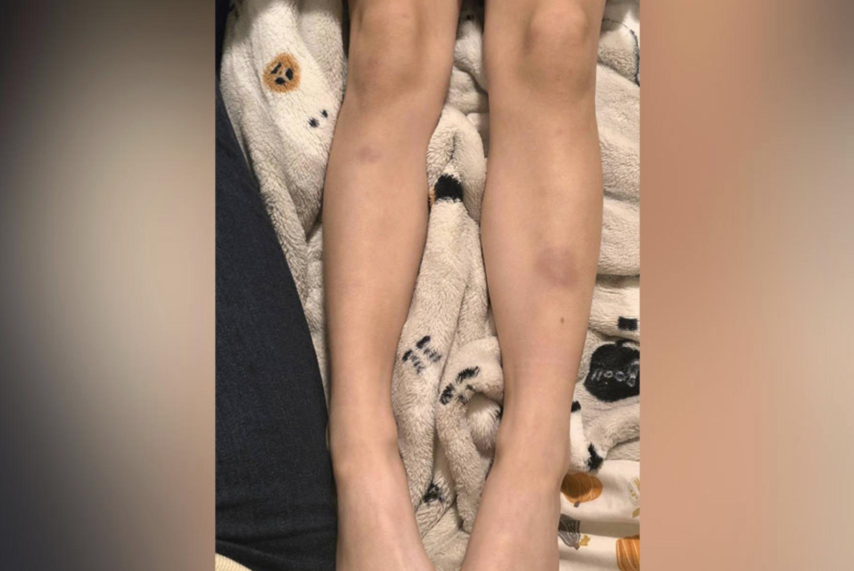 Bruises can be seen on 6-year-old Valerie Jensen’s legs. Her mother, Katelynn Jensen, says doctors are puzzled as to what is causing the bruises as well as half of Valarie’s body to “shrink.”
