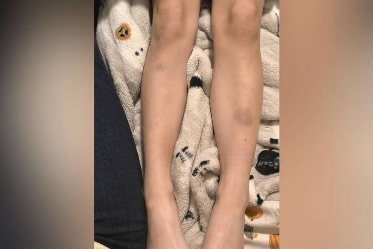 Bruises can be seen on 6-year-old Valerie Jensen’s legs. Her mother, Katelynn Jensen, says doctors are puzzled as to what is causing the bruises as well as half of Valarie’s body to “shrink.”