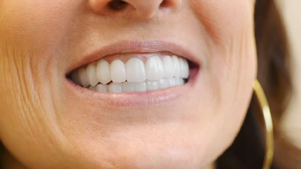 The Utah-born dental implant procedure that is replacing All-on-4