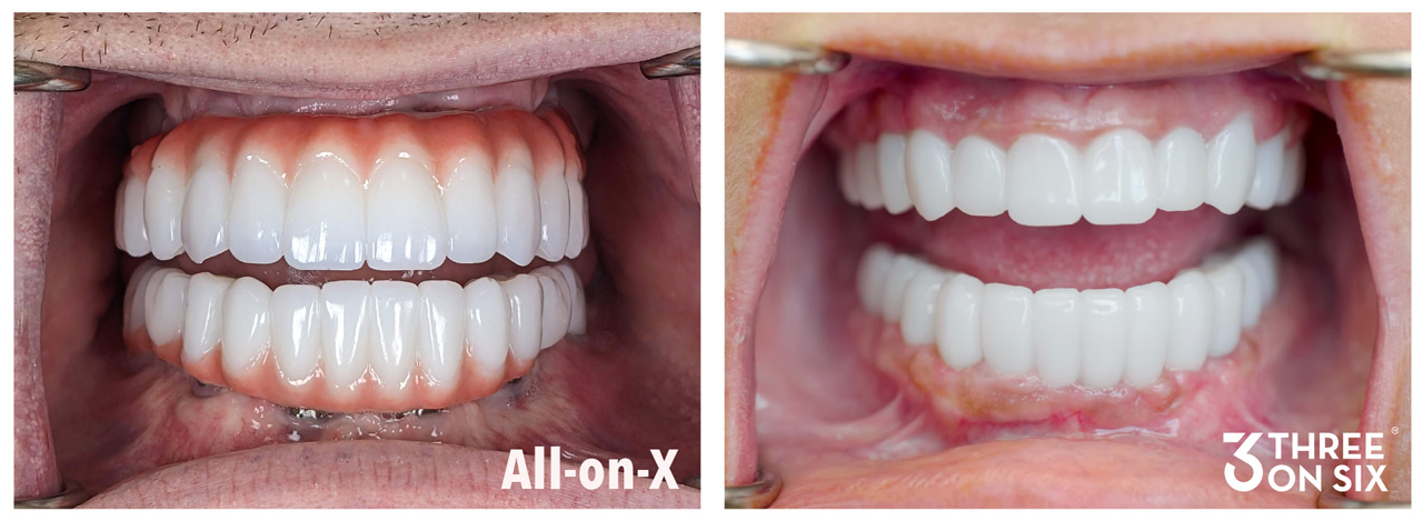 The Utah-born dental implant procedure that is replacing All-on-4