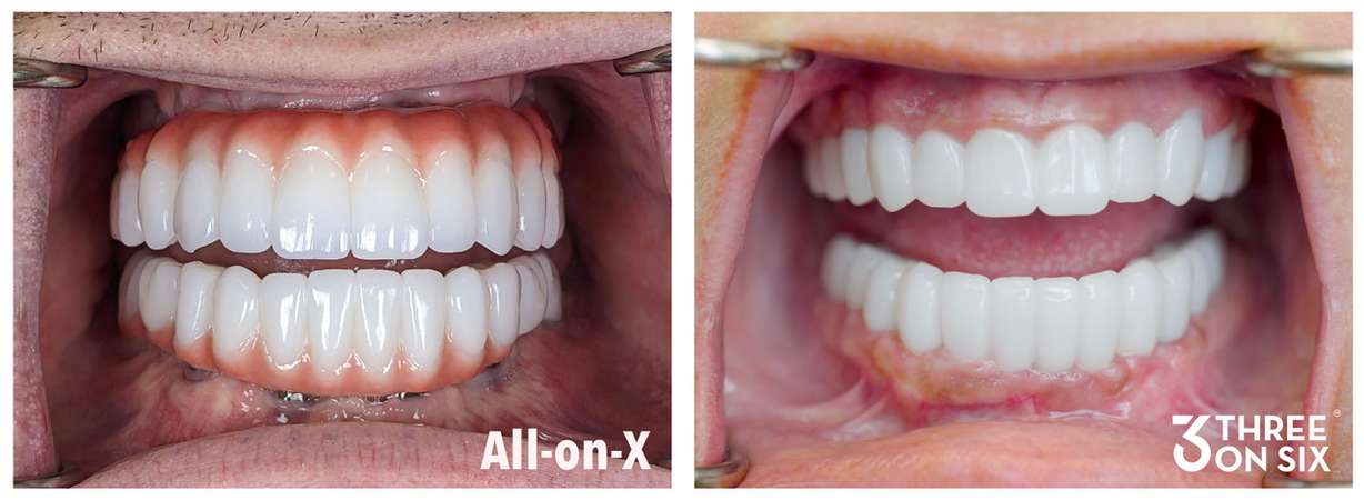 The Utah-born dental implant procedure that is replacing All-on-4