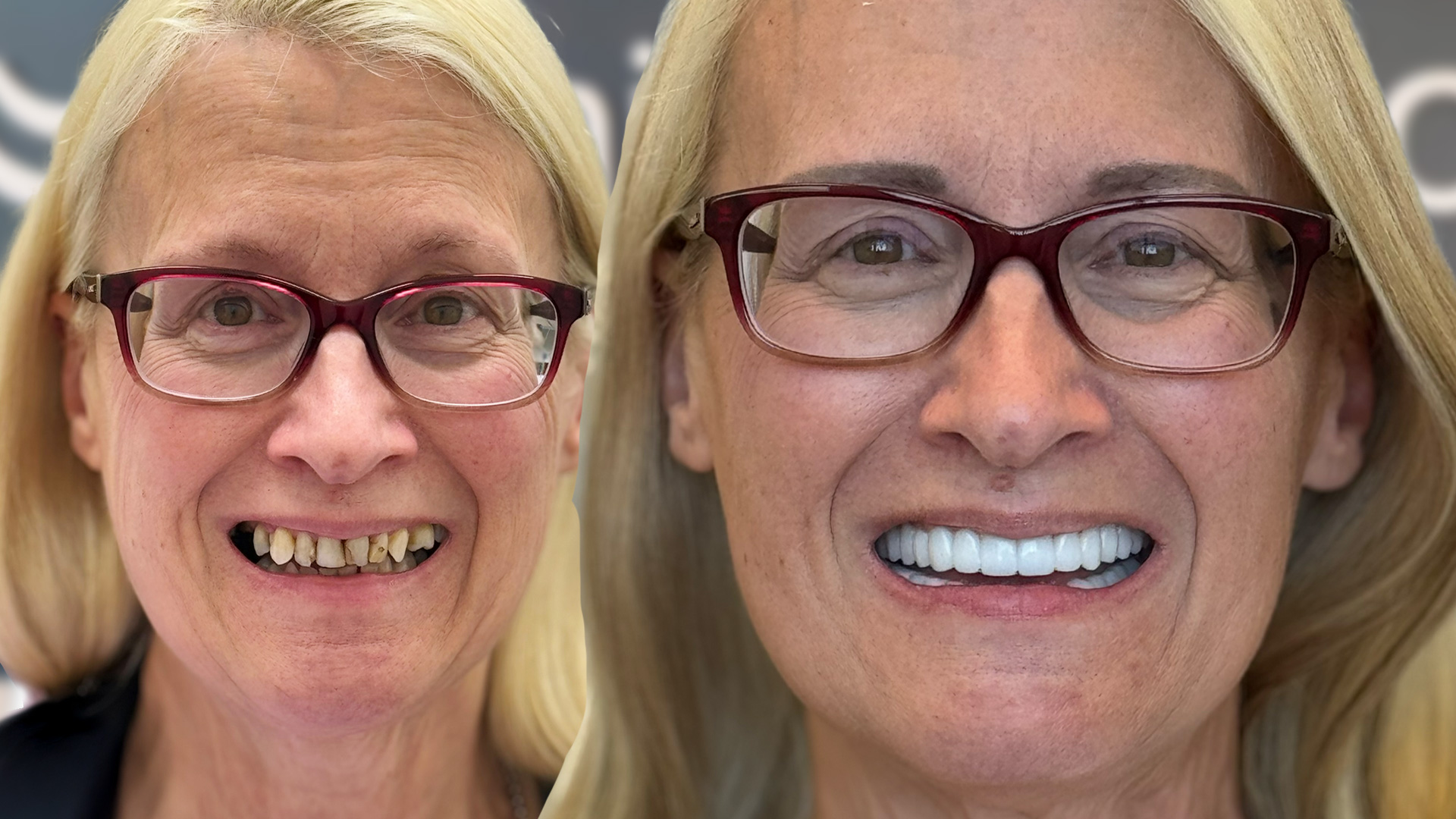 The Utah-born dental implant procedure that is replacing All-on-4