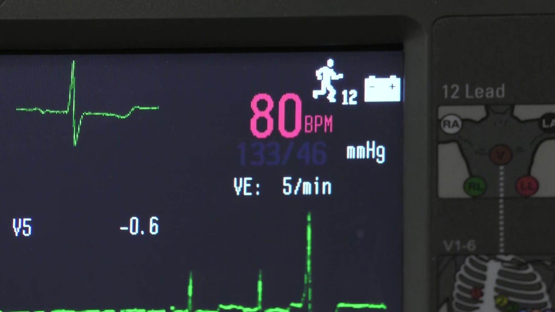 Irregular heartbeat? Experts say early care can prevent serious complications