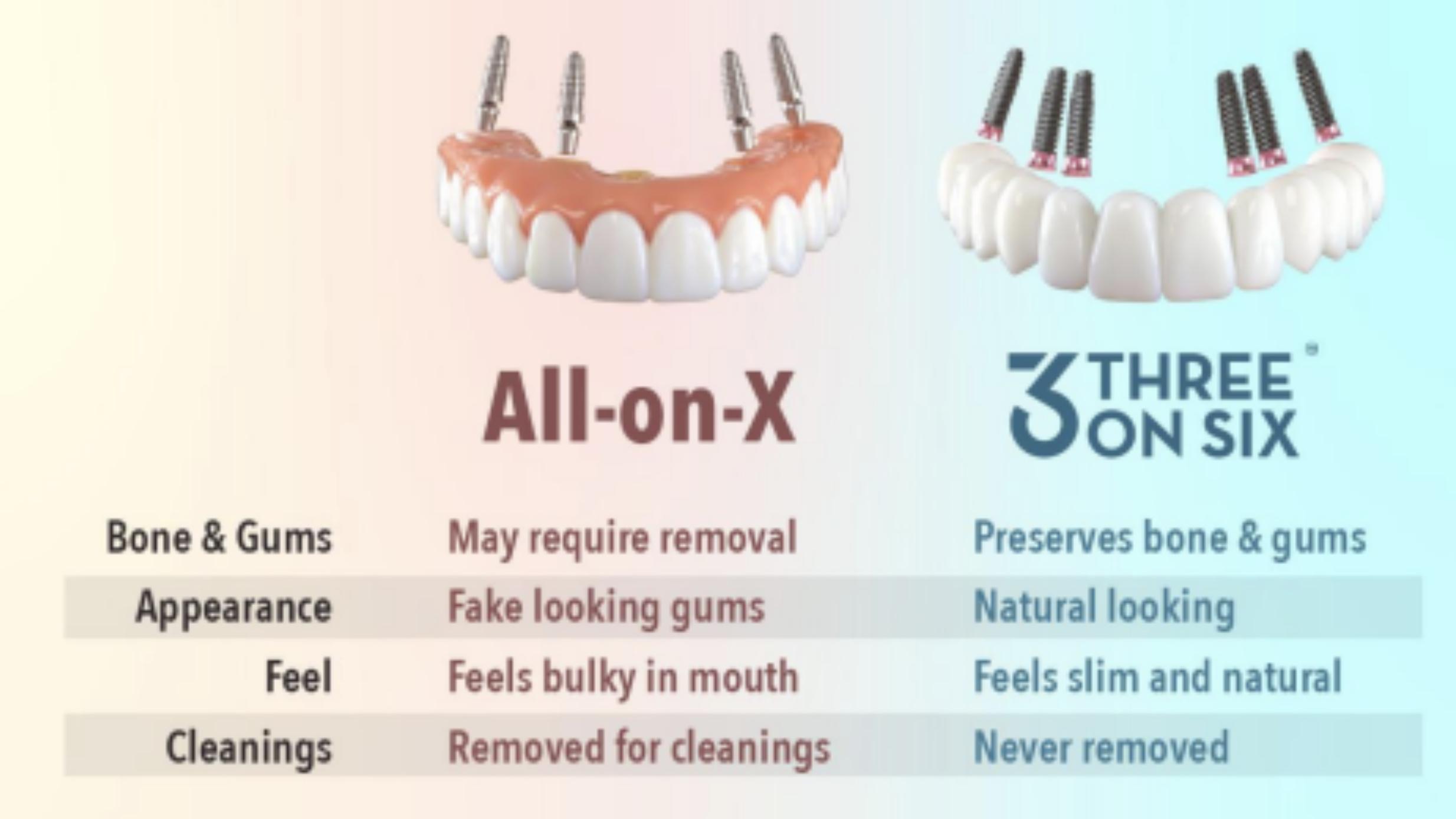 The Utah-born dental implant procedure that is replacing All-on-4