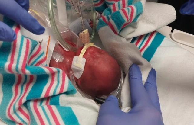 Mom shares 22-week preemie's miraculous NICU journey through photos to inspire other parents
