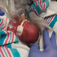 Mom shares 22-week preemie's miraculous NICU journey through photos to inspire other parents