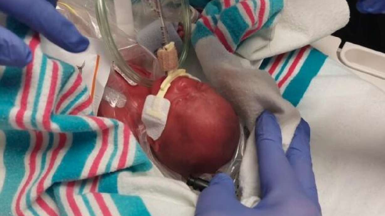 Logan Ames was born at 22 weeks and 1 day. A Blackfoot mother who documented her baby’s growth in the NICU with unique photos hopes her family’s journey inspires others in similar situations.
