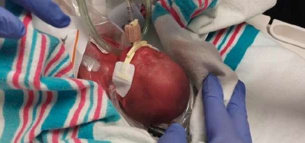 Mom shares 22-week preemie's miraculous NICU journey through photos to inspire other parents
