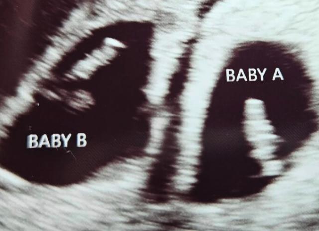 An ultrasound showing Taylor and Riley Ames, who died at 19 and 20 weeks.