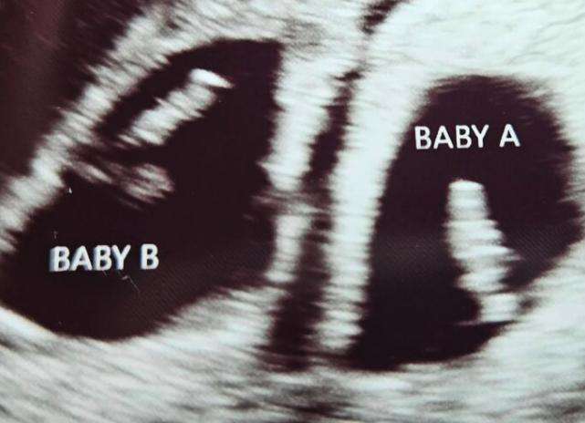An ultrasound showing Taylor and Riley Ames, who died at 19 and 20 weeks.