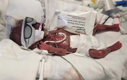 Mom shares 22-week preemie's miraculous NICU journey through photos to inspire other parents