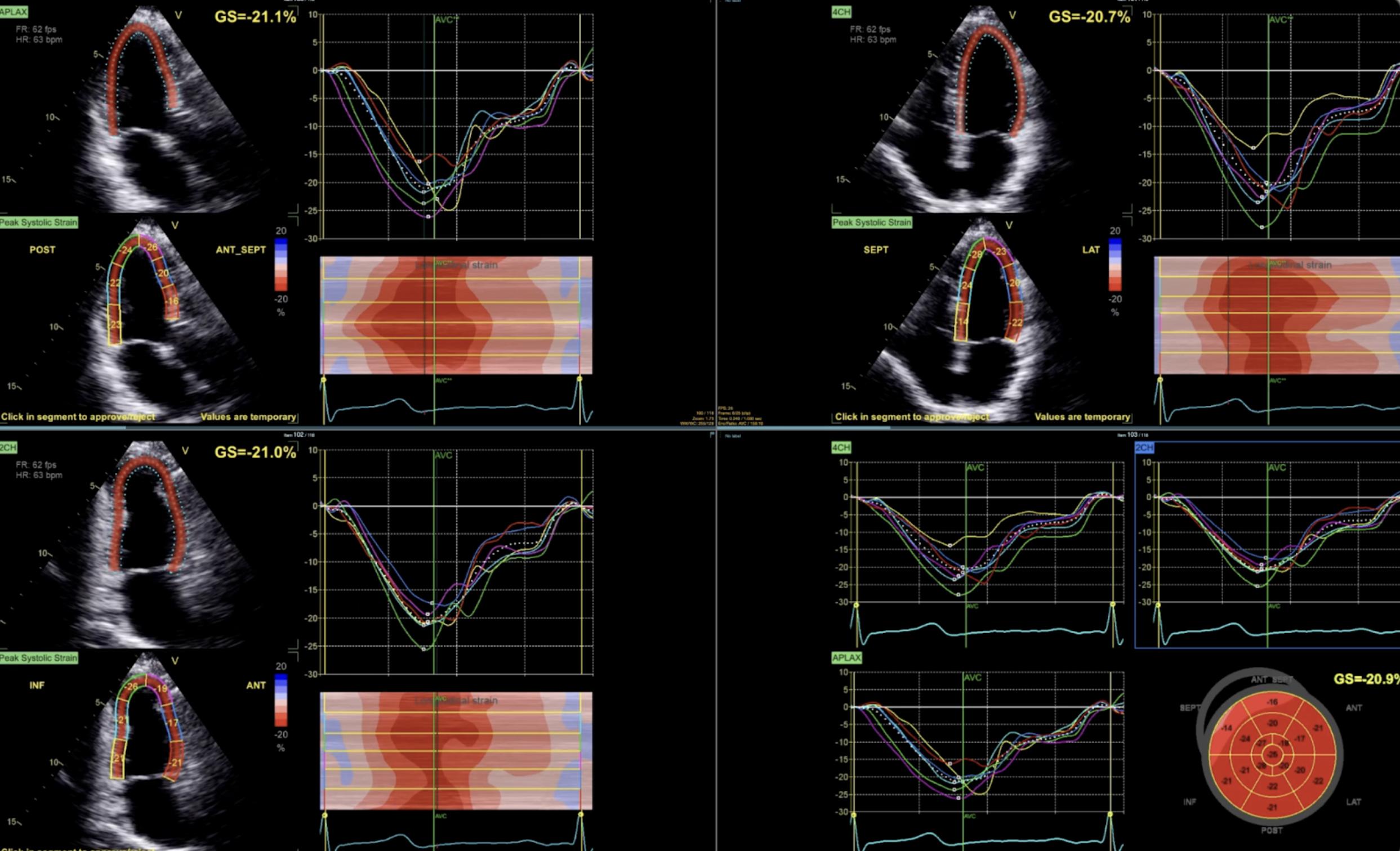 Utah clinic offers lower cost heart scans without the wait or a doctor's order