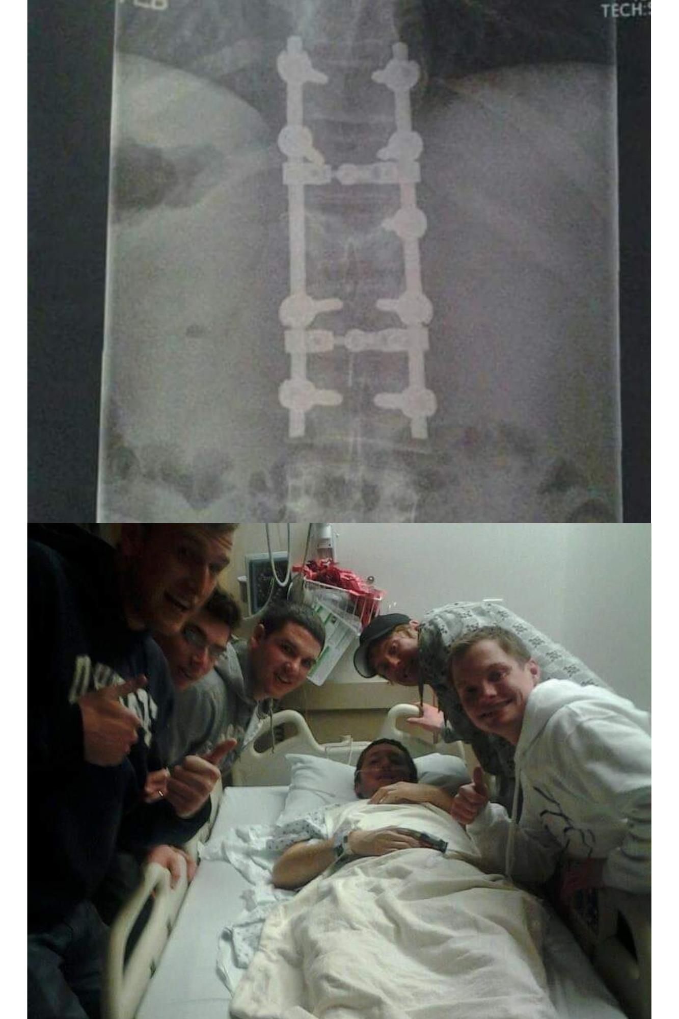Top, X-rays show Michael McKnight's broken back. Bottom, McKnight lies in a hospital bed, surrounded by friends, after surgery to repair his back.