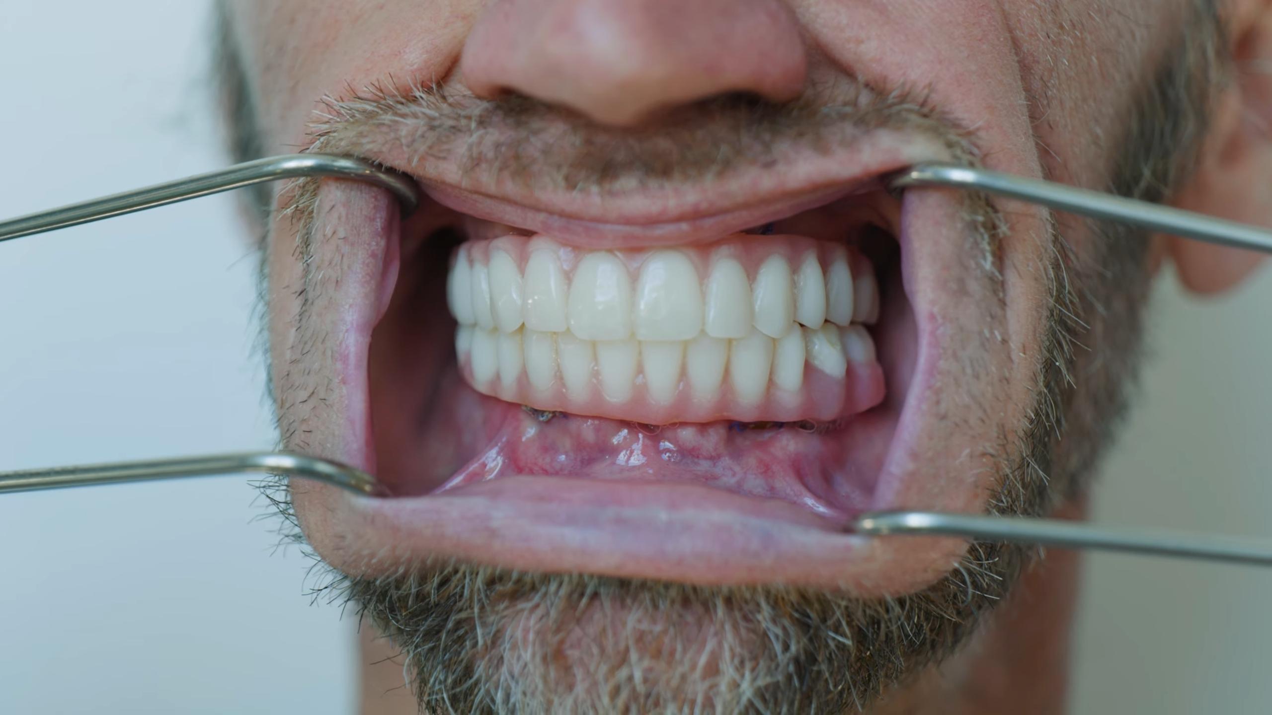 Utah man's trip to Mexico for dental implants cost him more than just money