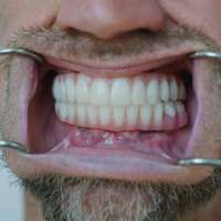 Utah man's trip to Mexico for dental implants cost him more than just money