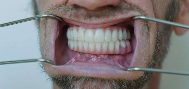 Utah man's trip to Mexico for dental implants cost him more than just money