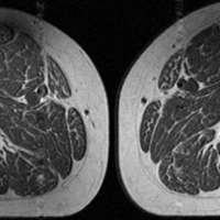 Ultraprocessed foods are turning human thighs into well-marbled steaks
