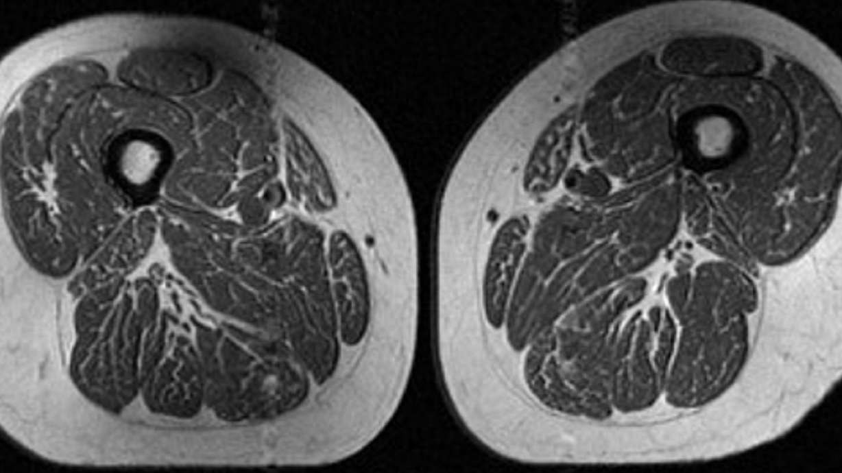 An MRI scan of a woman's thighs. Her diet was 87% ultraprocessed.