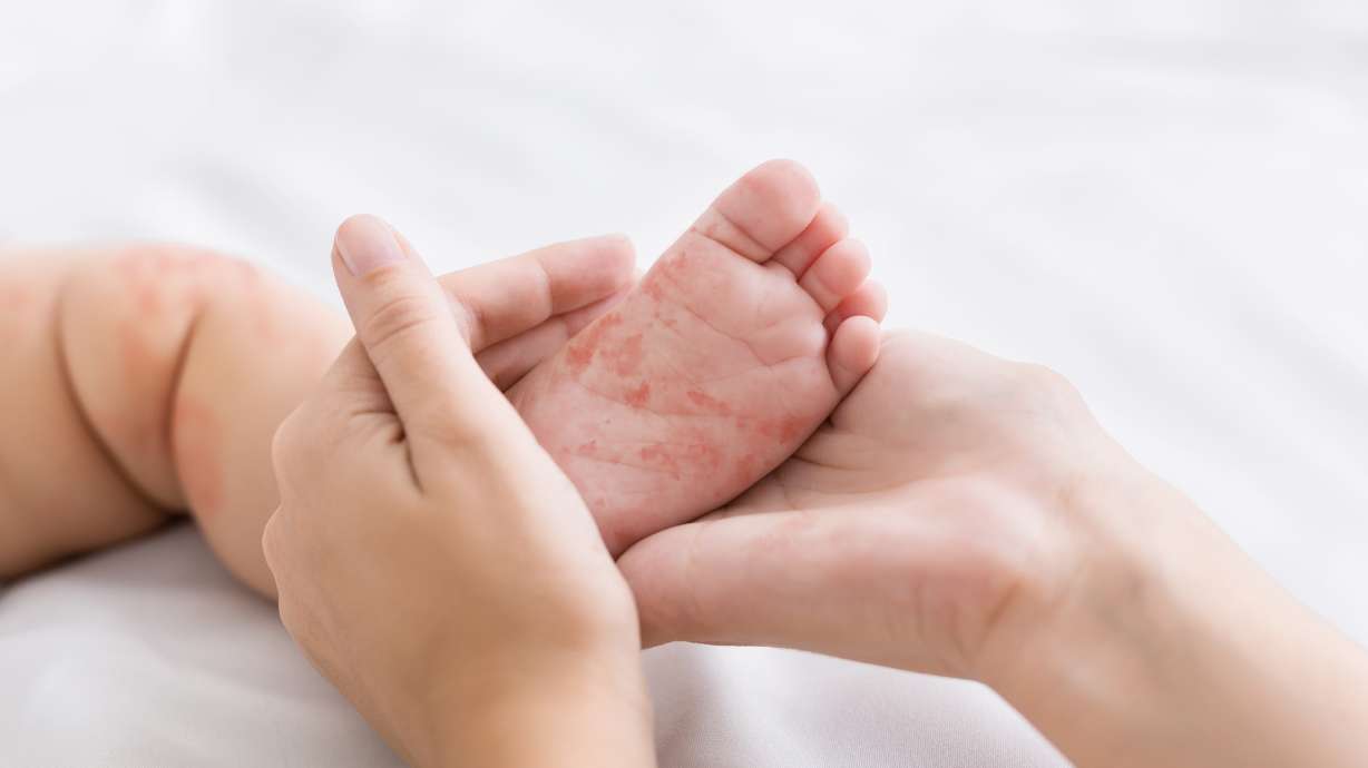 Learning from the measles outbreak: The importance of effective health administration