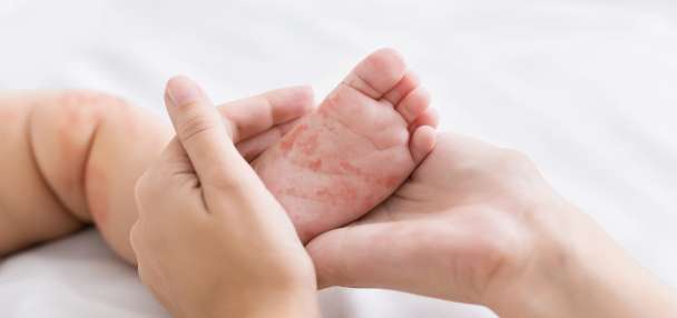 Learning from the measles outbreak: The importance of effective health administration