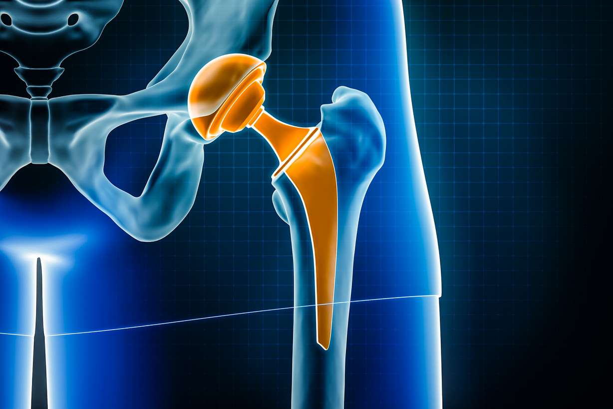 Rapid recovery revolution: How modern joint replacement is changing lives