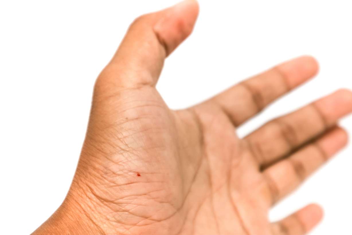 How did a carpenter contract hepatitis C at work?