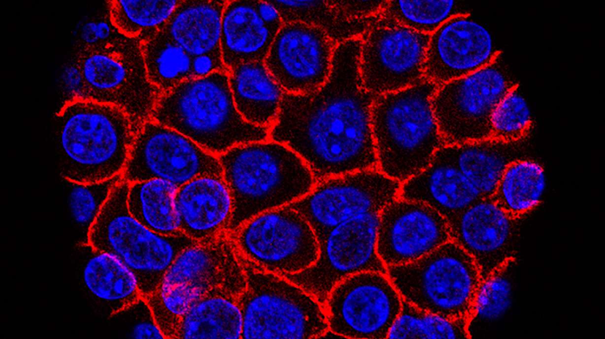This undated microscope image from USC via the NIH shows pancreatic cancer cells, nuclei in blue, growing as a sphere encased in membranes, red.