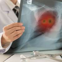 Survivor, advocate: Inexpensive radon test can head off lifelong lung cancer battle