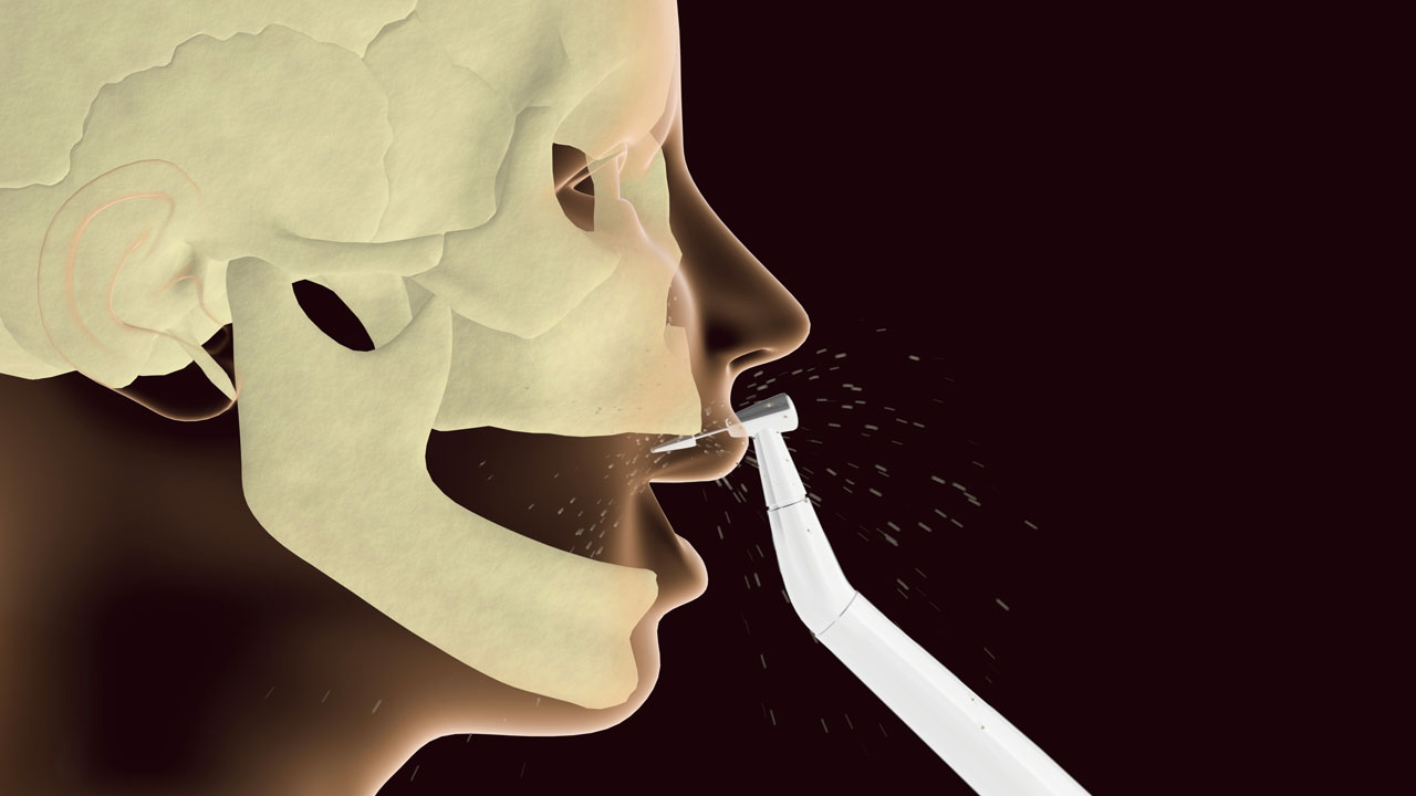 4 critical implant questions Utah dentists are avoiding