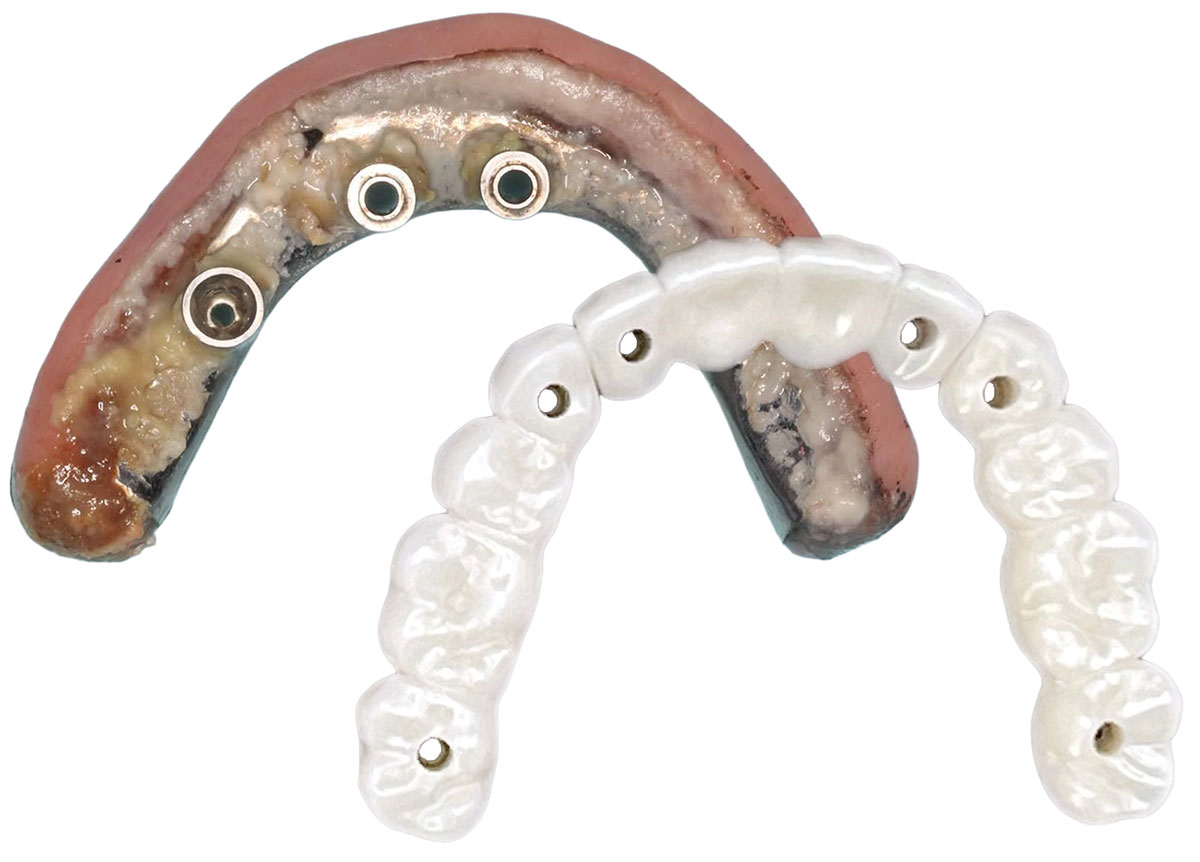 4 critical implant questions Utah dentists are avoiding