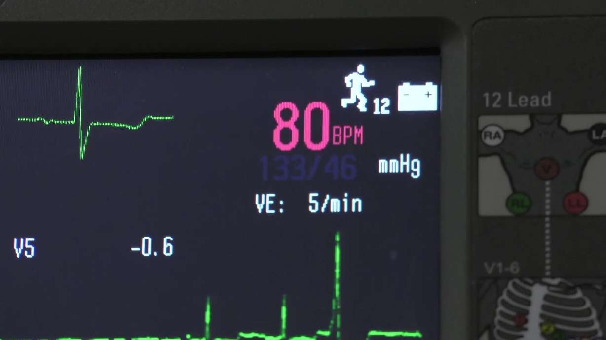 Irregular heartbeat? Experts say early care can prevent serious complications