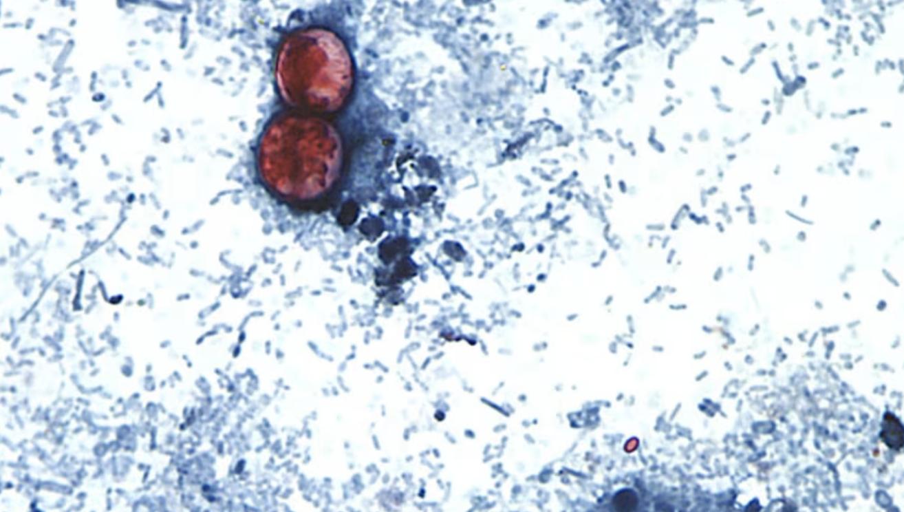 Outbreak of diarrhea caused by parasite jumps to more than 3,000 cases