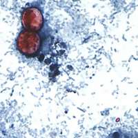 Outbreak of diarrhea caused by parasite jumps to more than 3,000 cases