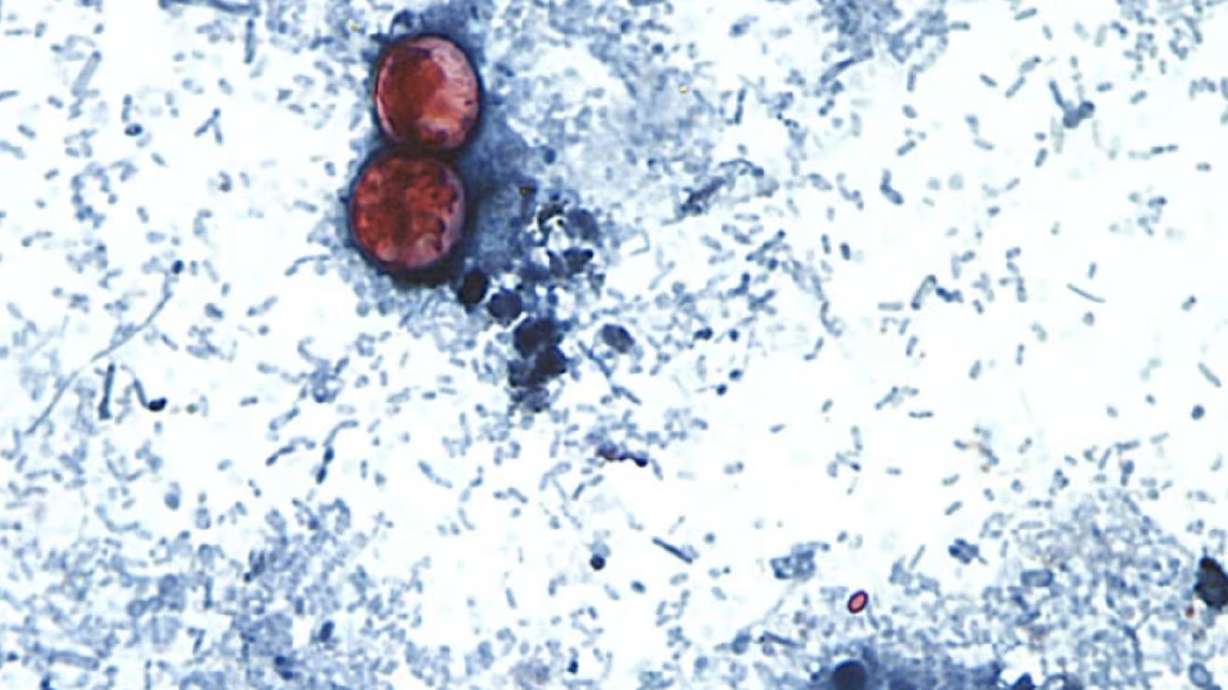 Cyclosporiasis is an intestinal infection caused by the cyclospora cayetanensis parasite, shown here through a microscope on a slide.