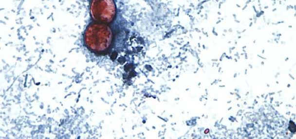 Outbreak of diarrhea caused by parasite jumps to more than 3,000 cases