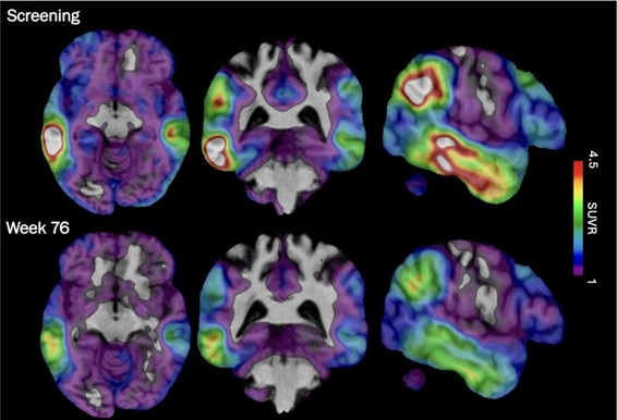An experimental Alzheimer's drug shows some promise as researchers hunt new approaches