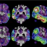 An experimental Alzheimer's drug shows some promise as researchers hunt new approaches