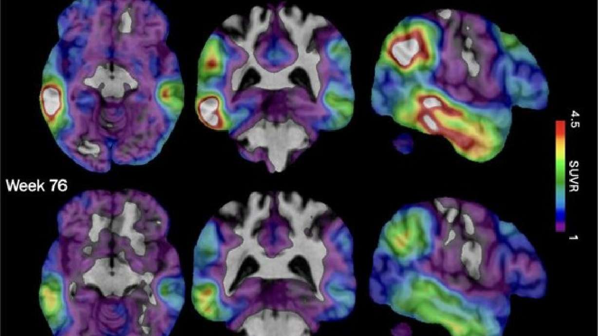 Brain scan images show how high levels of Alzheimer's-related tau protein, in red, dropped in a recipient of Biogen's experimental drug diranersen, which might help slow the disease in a different way, researchers said on Tuesday.