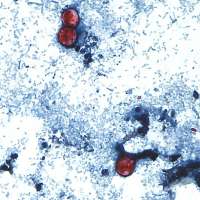 First deaths reported in cyclosporiasis outbreak