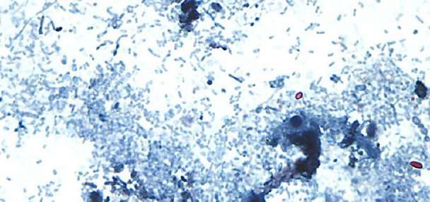 First deaths reported in cyclosporiasis outbreak
