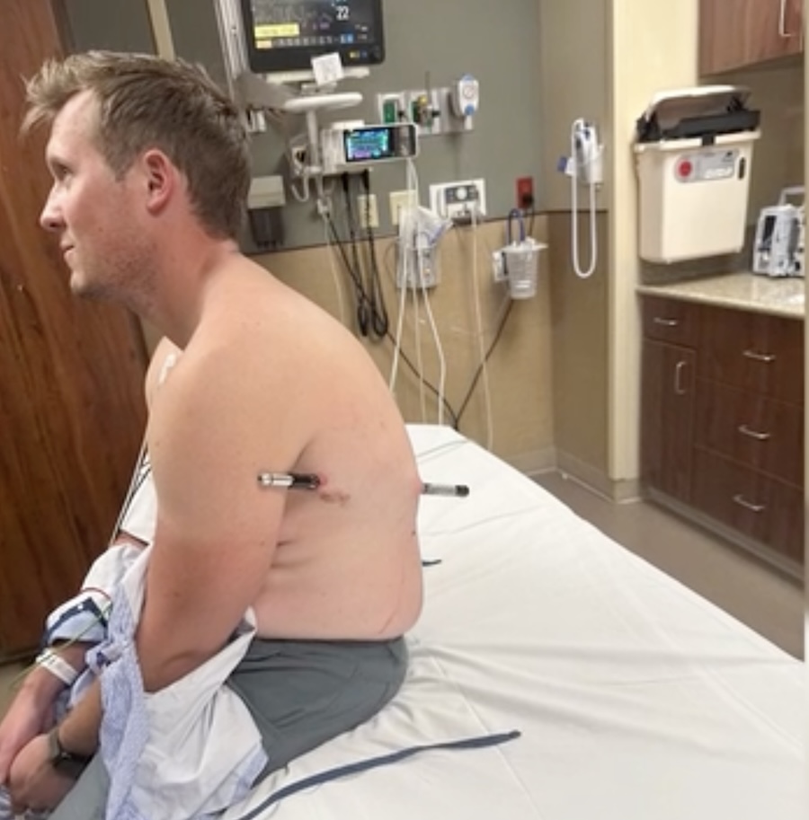 David Cifaldi is pictured after he slipped, causing one of his trekking poles to impale him through his back and out his side.