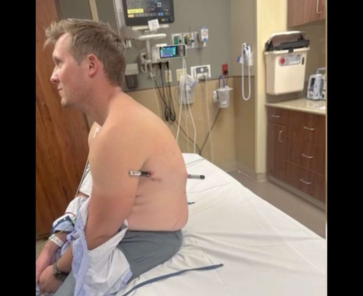 David Cifaldi is pictured after he slipped, causing one of his trekking poles to impale him through his back and out his side.