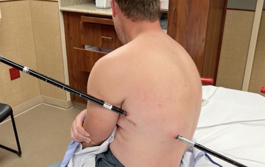 Man impales himself on trekking pole, hikes 10 miles down Montana's tallest mountain with it still in body